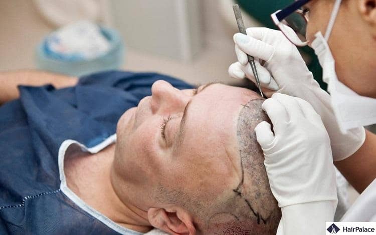 Why German males choose Budapest and not Istanbul for hair loss surgery?